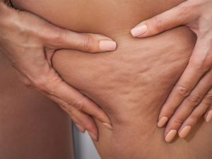 La cellulite chez les femmes enceintes