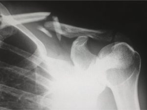 Lutter efficacement contre l’arthrose.