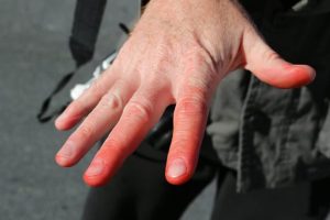 Comment se protéger des engelures avec l’arrivée du froid?