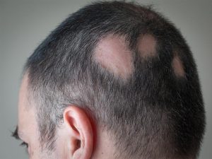 La chute des cheveux, les causes de cet maladie et que peut-on faire vraiment pour l’éviter ?