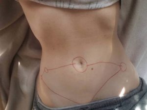 Une femme sur 10 souffre d’endométriose !
